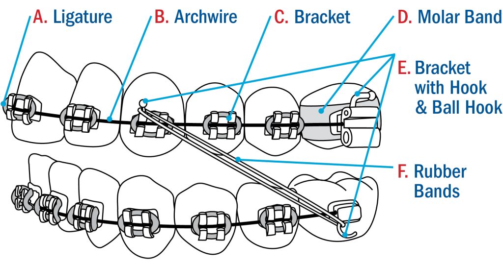 Braces Diagram Shore Children's Dental Care